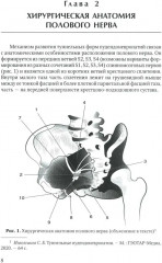 Диагностика и лечение невропатии половых нервов - Фото 4