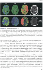 Ишемический инсульт: диагностика, лечение, реабилитация и профилактика. Руководство для врачей - Фото 12
