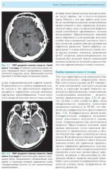 Лучевая диагностика заболеваний головного мозга - Фото 5
