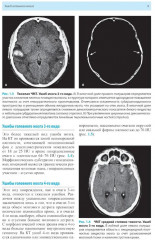 Лучевая диагностика заболеваний головного мозга - Фото 6