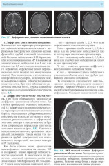 Лучевая диагностика заболеваний головного мозга - Фото 8
