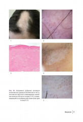 Первичные рубцовые алопеции. Диагностика и лечение. Иллюстрированное руководство для врачей - Фото 4