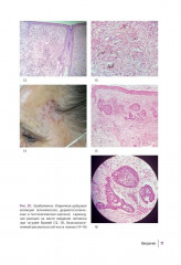 Первичные рубцовые алопеции. Диагностика и лечение. Иллюстрированное руководство для врачей - Фото 6