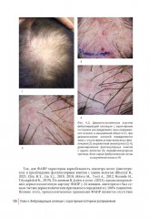 Первичные рубцовые алопеции. Диагностика и лечение. Иллюстрированное руководство для врачей - Фото 10