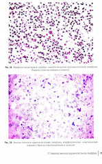 Неходжкинские лимфомы у детей и подростков - Фото 5