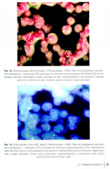 Неходжкинские лимфомы у детей и подростков - Фото 7