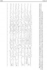 Клиническая электроэнцефалография (с элементами эпилептологии) - Фото 9