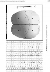 Клиническая электроэнцефалография (с элементами эпилептологии) - Фото 10