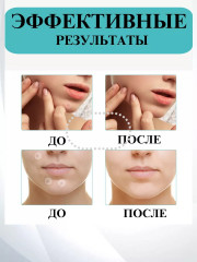 Набор патчей противовоспалительные от прыщей - Фото 4