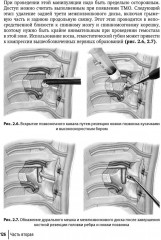 Техника и принципы хирургического лечения заболеваний и повреждений позвоночника - Фото 16