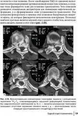 Техника и принципы хирургического лечения заболеваний и повреждений позвоночника - Фото 19