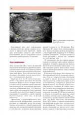 Стандартизация ультразвукового исследования миометрия и эндометрия (MUSA, IETA) - Фото 7
