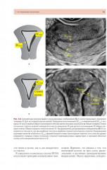 Стандартизация ультразвукового исследования миометрия и эндометрия (MUSA, IETA) - Фото 9