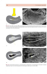 Стандартизация ультразвукового исследования миометрия и эндометрия (MUSA, IETA) - Фото 11