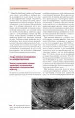 Стандартизация ультразвукового исследования миометрия и эндометрия (MUSA, IETA) - Фото 12