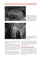 Стандартизация ультразвукового исследования миометрия и эндометрия (MUSA, IETA) - Фото 13