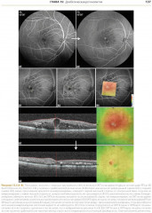 ОКТ-ангиография. Клинический атлас - Фото 4