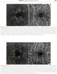 ОКТ-ангиография. Клинический атлас - Фото 6