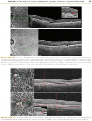 ОКТ-ангиография. Клинический атлас - Фото 9
