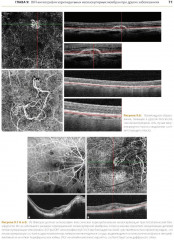 ОКТ-ангиография. Клинический атлас - Фото 10
