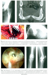 Травматология детского возраста - Фото 9