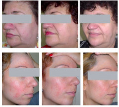 Крем против покраснений с фотозащитой при розацеа, куперозе и демодекозе SPF50+ «Quasix» - Фото 1