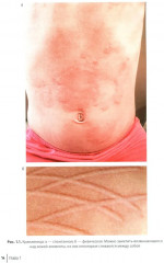 Крапивница у детей. Клиника, диагностика, лечение - Фото 8