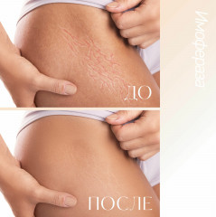 Крем от шрамов, рубцов, растяжек и пигментации «Имофераза» - Фото 2