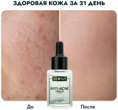Сыворотка для лица против акне с ниацинамидом «Anti-Acne Serum» - Фото 8
