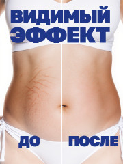 Крем от растяжек, рубцов и шрамов - Фото 1