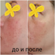 Отзыв на EFFACLAR DUO(+) Корректирующий крем-гель для проблемной кожи от Галина