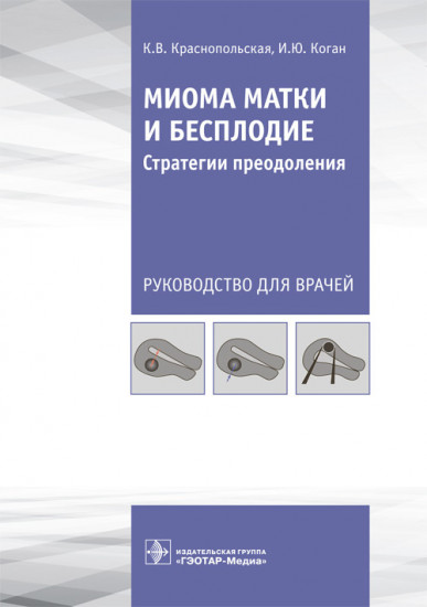 Миома матки и бесплодие