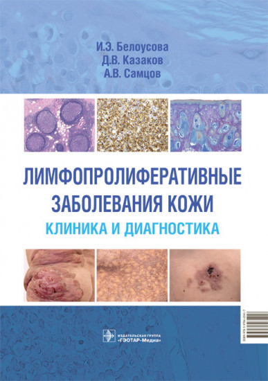 Лимфопролиферативные заболеванания кожи
