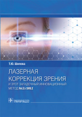 Лазерная коррекция зрения