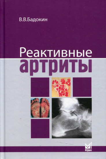 Реактивные артриты. Урогенитальные и постэнтероколитические