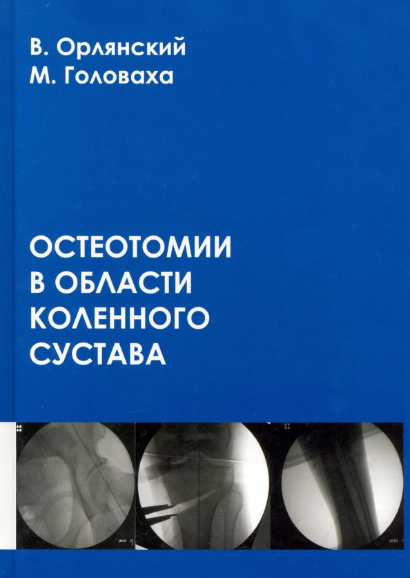 Остеотомии в области коленного сустава