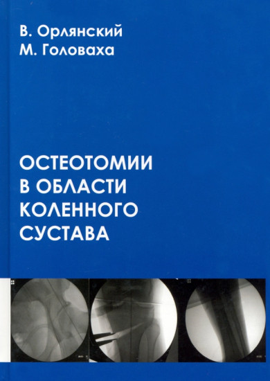 Остеотомии в области коленного сустава
