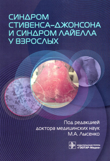 Синдром Стивенса-Джонсона