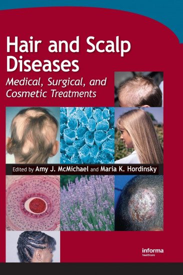 Hair and Scalp Diseases