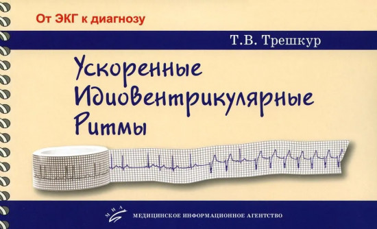 Ускоренные идиовентрикулярные ритмы