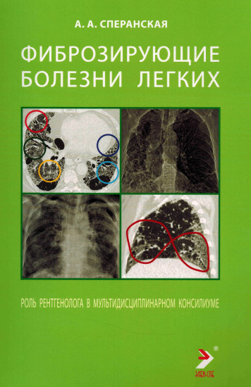 Фиброзирующие болезни легких. Роль рентгенолога в мультидисциплинарном консилиуме