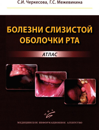 Болезни слизистой оболочки рта. Атлас
