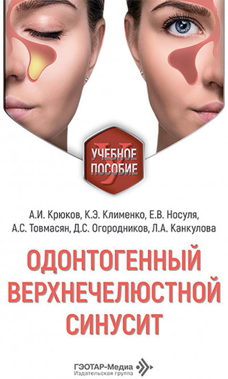 Одонтогенный верхнечелюстной синусит