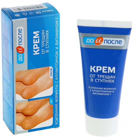 Крем от трещин в ступнях «До и После»