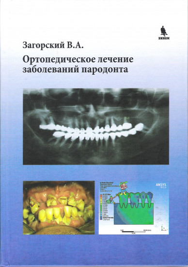 Ортопедическое лечение заболеваний пародонта
