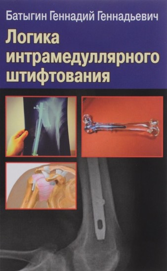 Логика интрамедуллярного штифтования