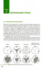 Клапанные пороки сердца - Фото 6