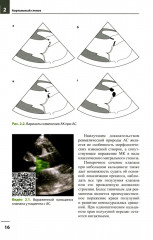 Клапанные пороки сердца - Фото 9