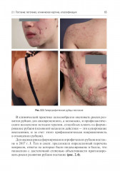 Акне и розацеа. Клинические проявления, диагностика и лечение - Фото 10