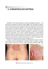 Псориаз. Диагностика, лечение и профилактика - Фото 9